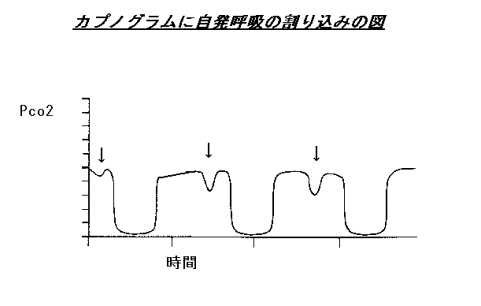 カプノメトリー_1.gif