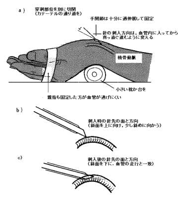 catheter.jpg