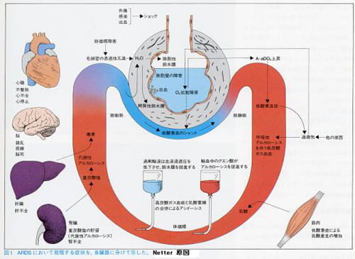 ARDSで出る症状と病態の関係｜血液ガス博物館｜ラジオメーター ...